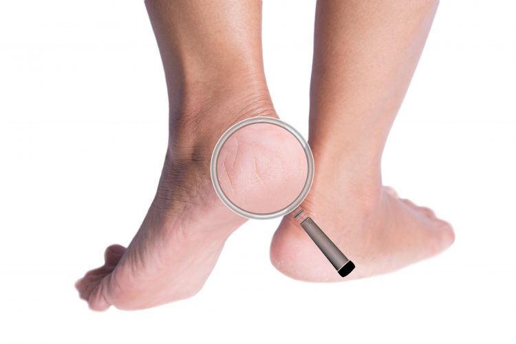 Corns on the heels