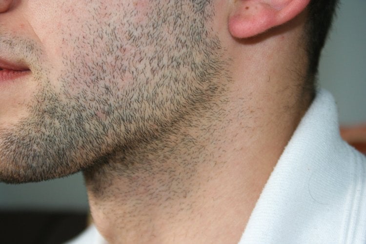 青髭の原因①「濃い毛が生えている」