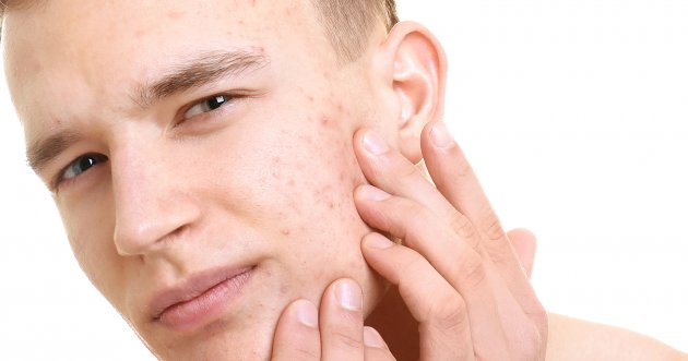 What are the causes of acne scars and how to care for them?
