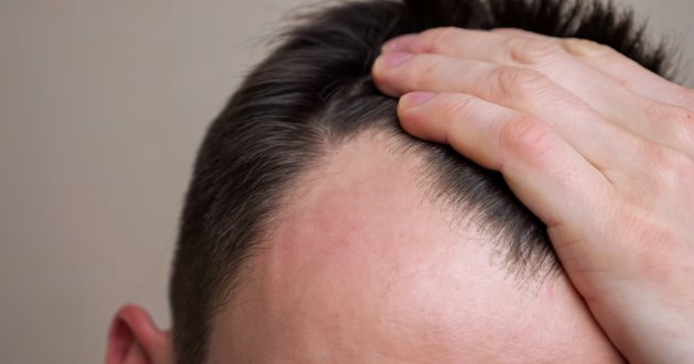 前髪はげの原因と前兆とは？症状についての解説と対策をおすすめのケアアイテムとともに紹介！