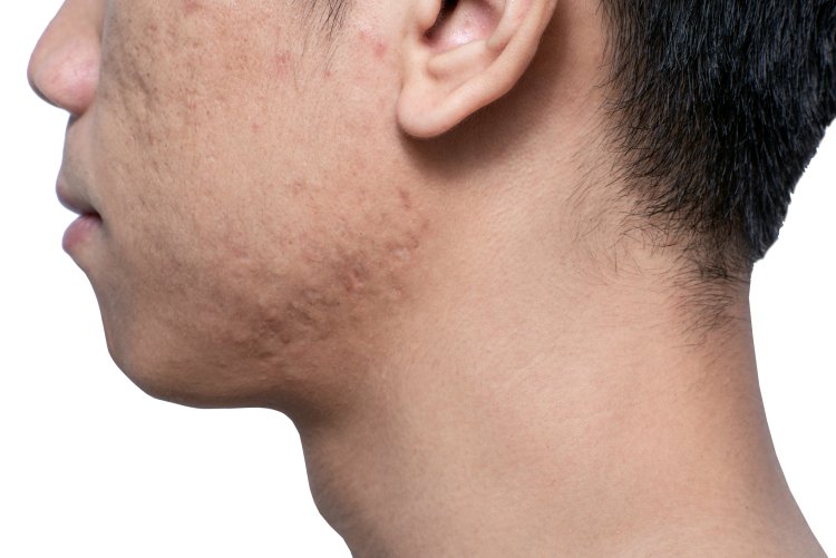 Why do acne scars form? Explained by condition!