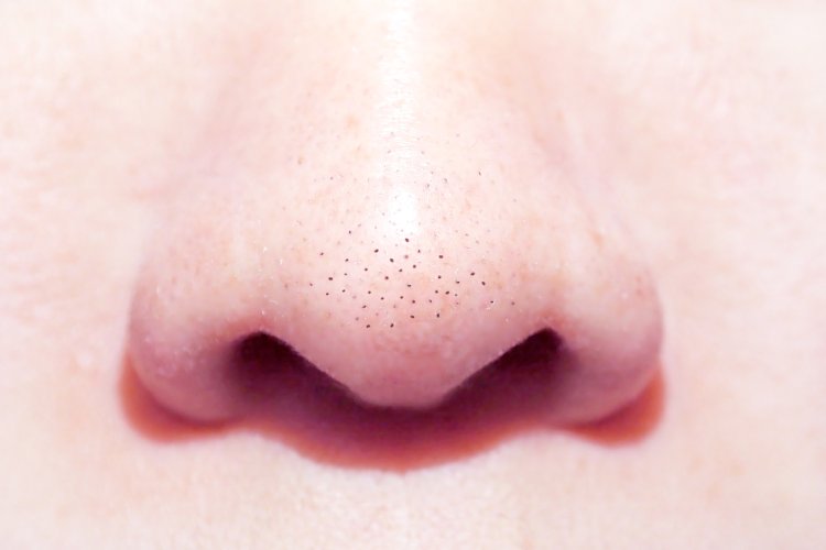 What causes blackheads in the pores of the nose?