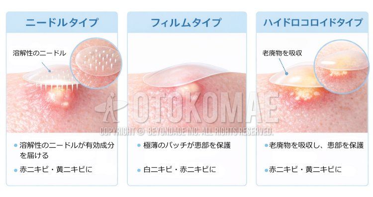 ニキビパッチ種類