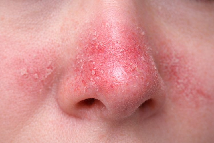 irritative dermatitis