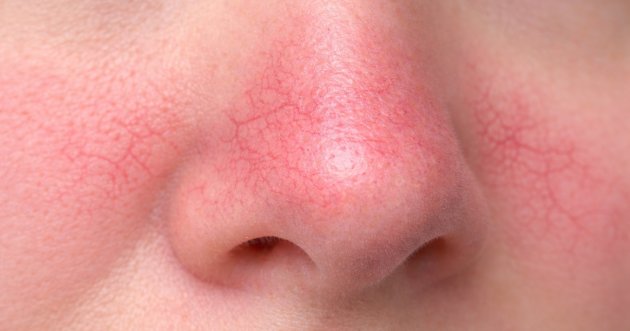 Redness of the nose is seen unexpectedly! What are the causes and countermeasures?
