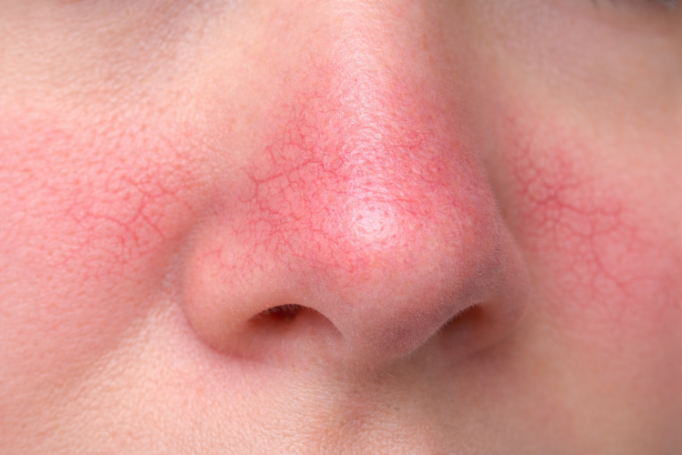 capillary dilation