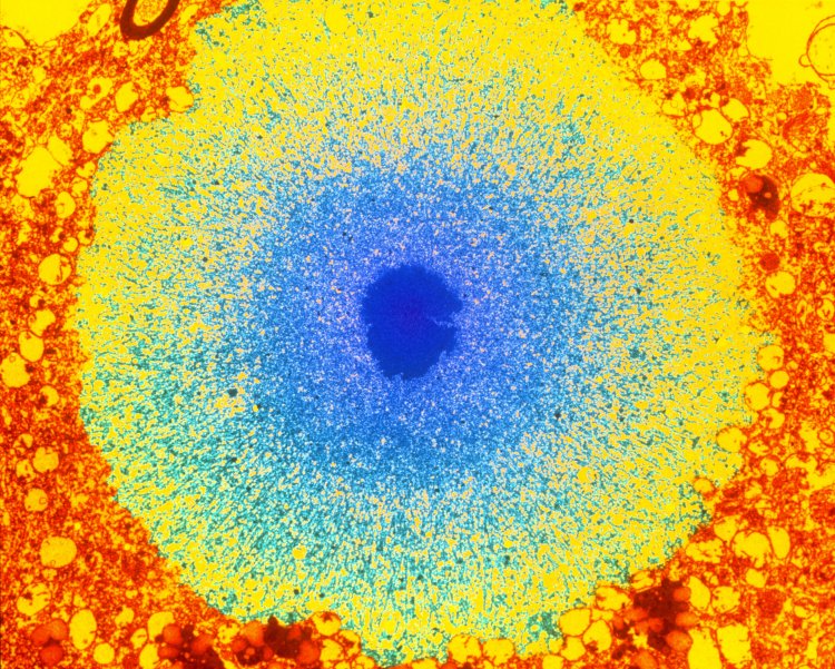 Colored TEM image of a Lewy body in Parkinson's disease
